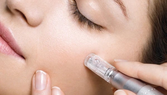 Microneedling 